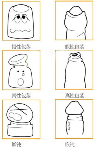 什么情况才需要割包皮？